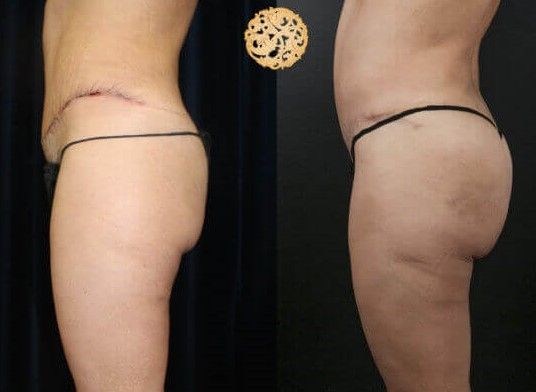 Non Surgical Butt Augmentation Before & After