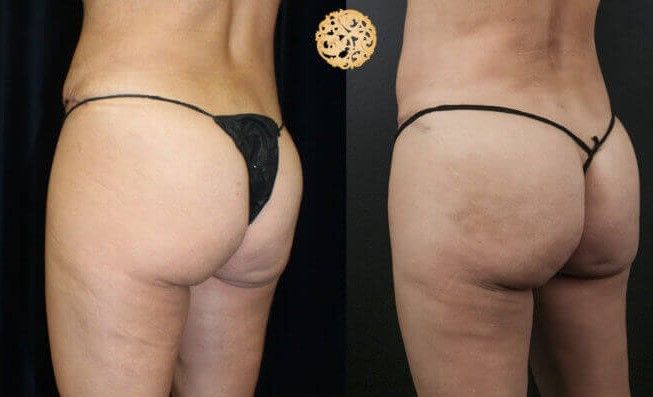 Non Surgical Butt Augmentation Before & After