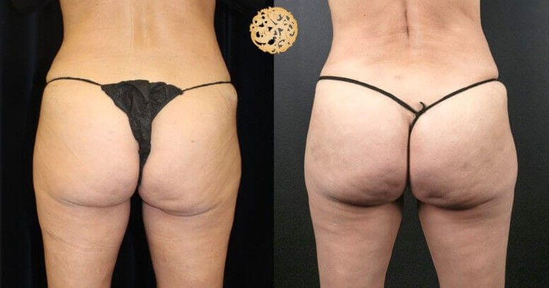 Non Surgical Butt Augmentation Before & After