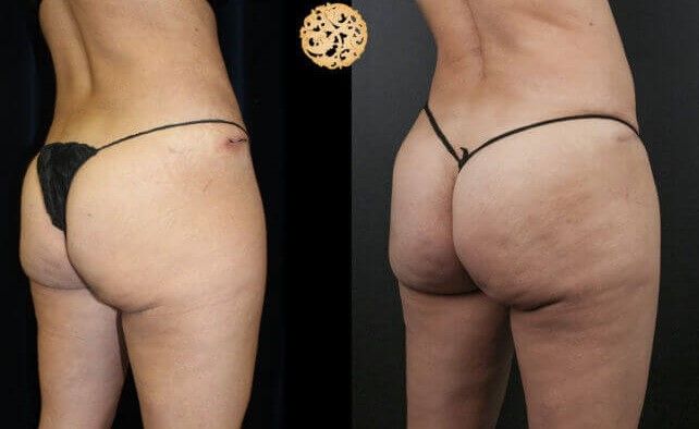Non Surgical Butt Augmentation Before & After