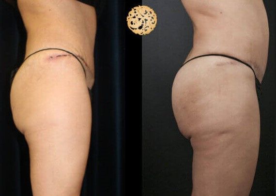 Non Surgical Butt Augmentation Before & After