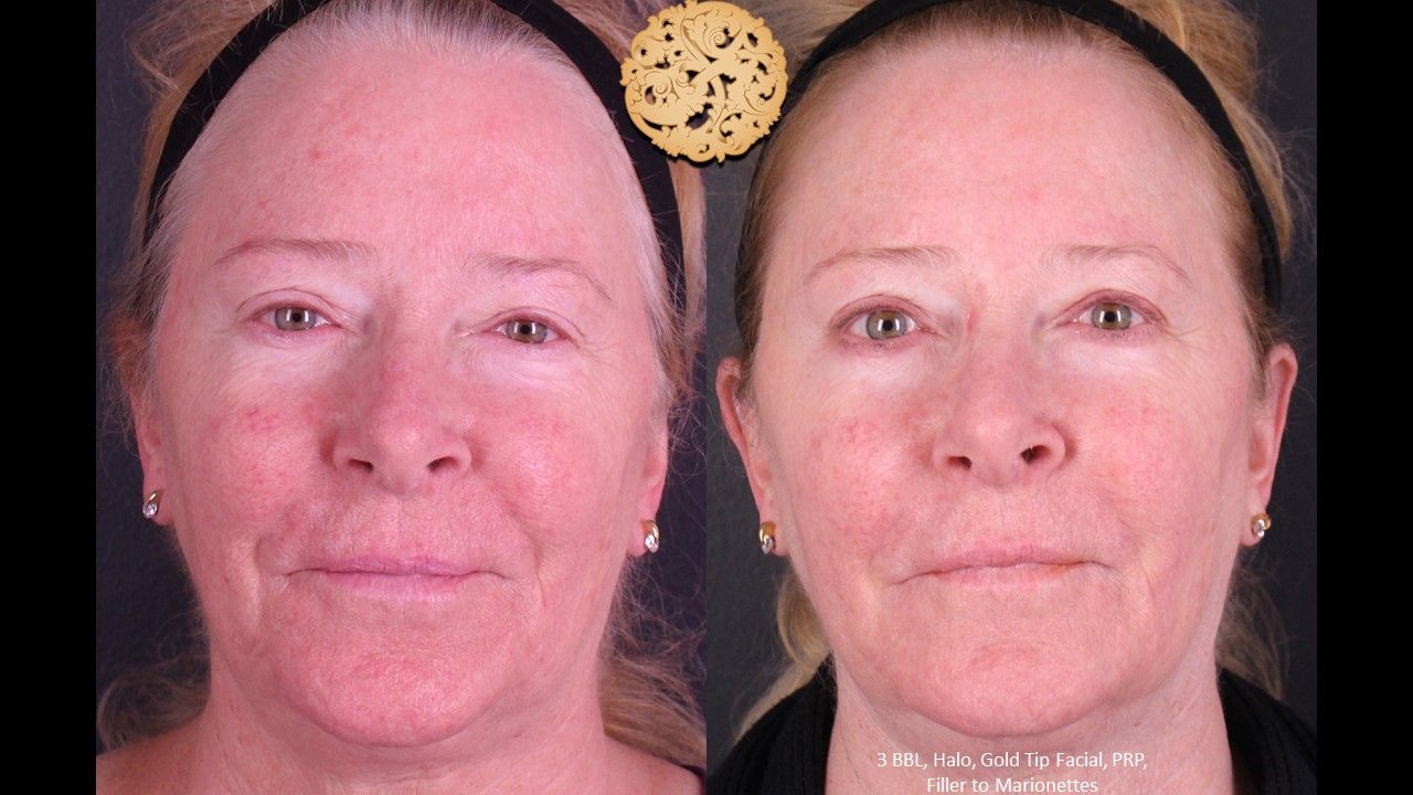 Prp Injections Before & After