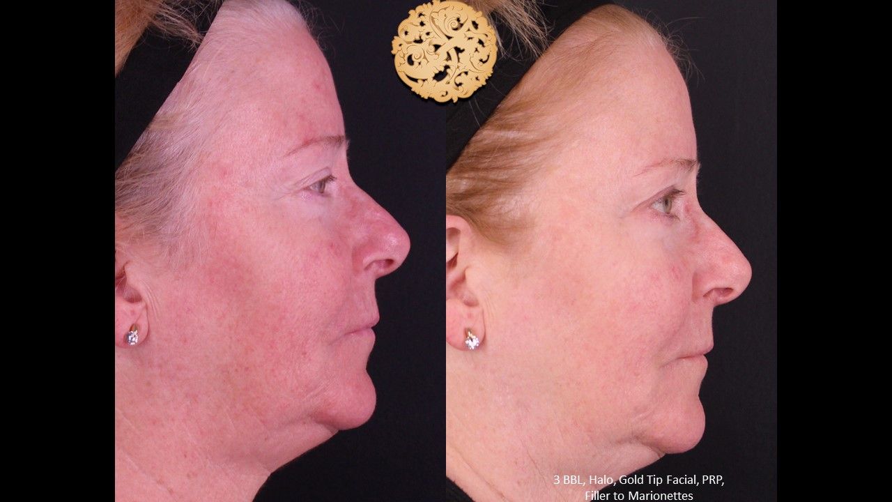 Prp Injections Before & After