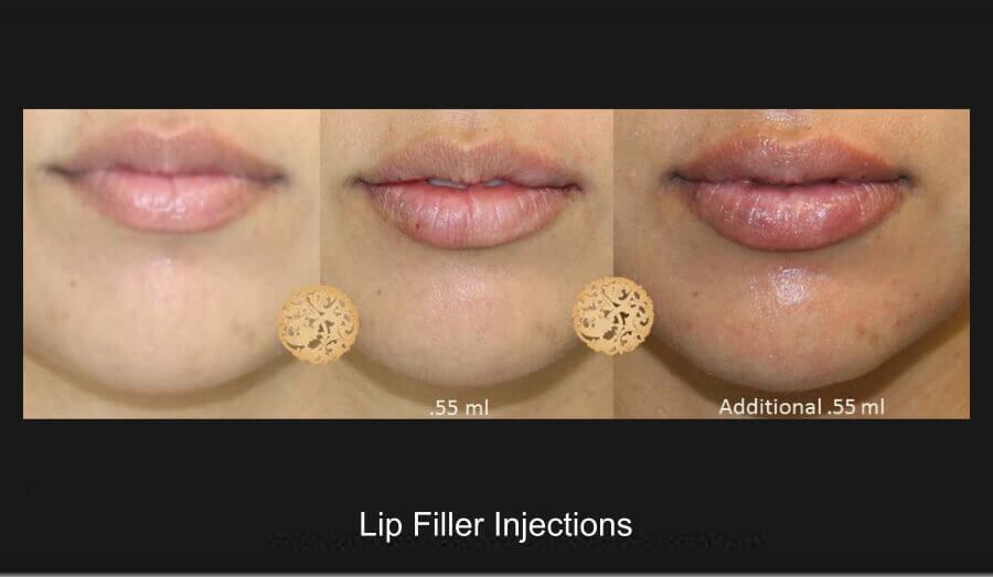 Lip Filler Before & After