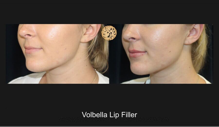 Lip Filler Before & After
