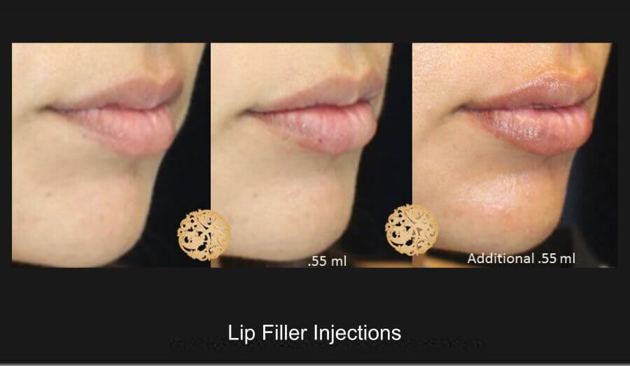 Lip Filler Before & After