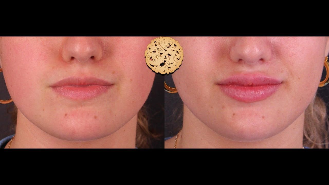 Lip Filler Before & After