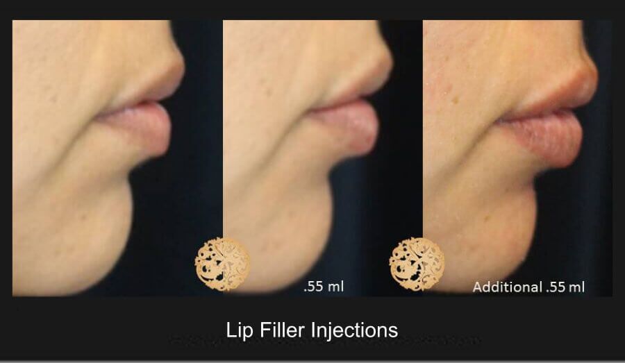 Lip Filler Before & After
