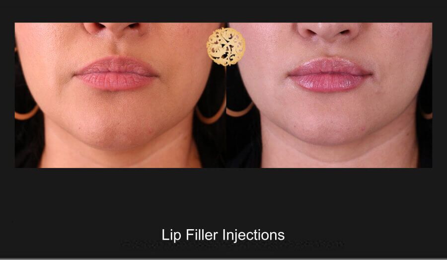 Lip Filler Before & After