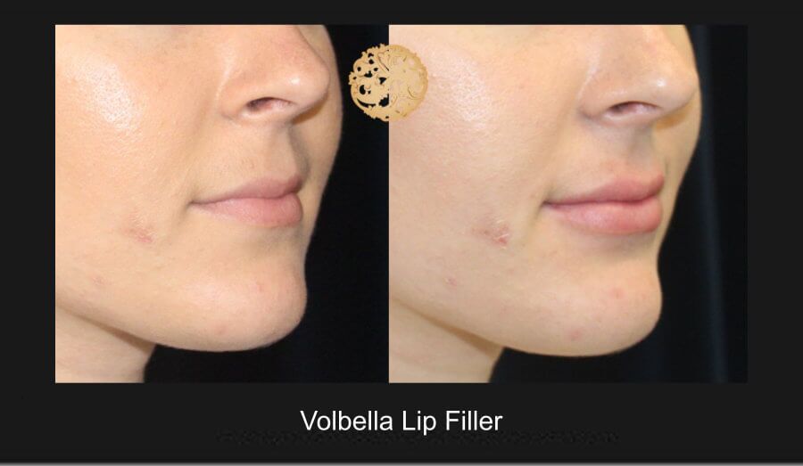 Lip Filler Before & After