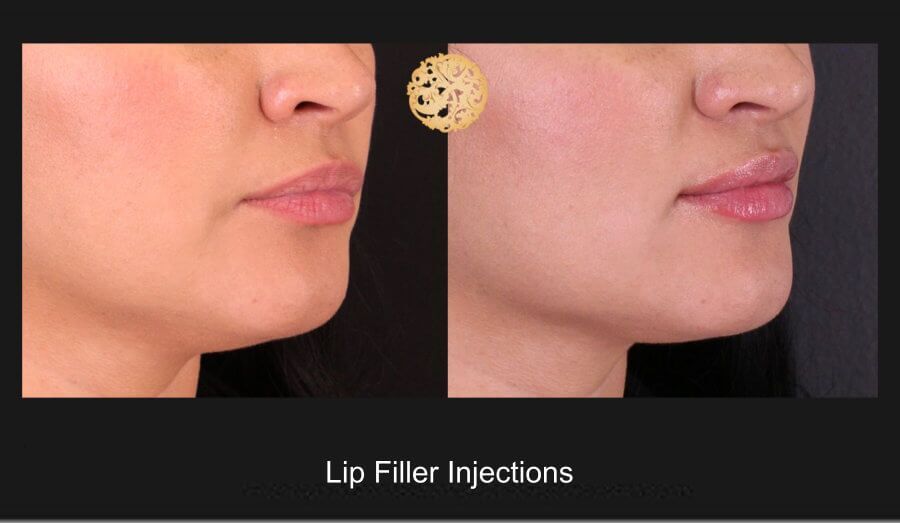 Lip Filler Before & After