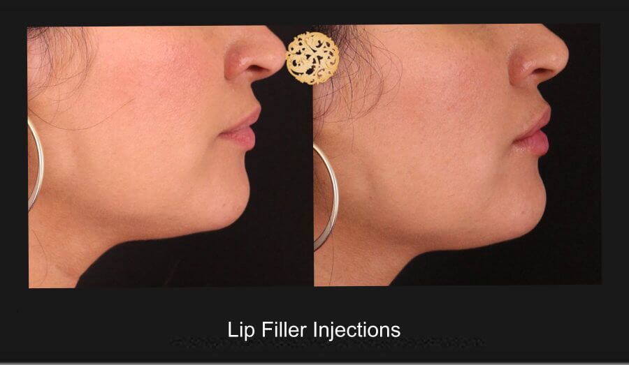 Lip Filler Before & After