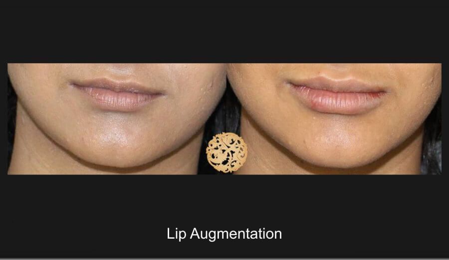 Lip Filler Before & After