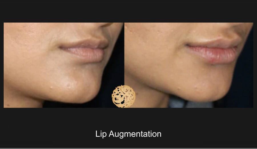 Lip Filler Before & After