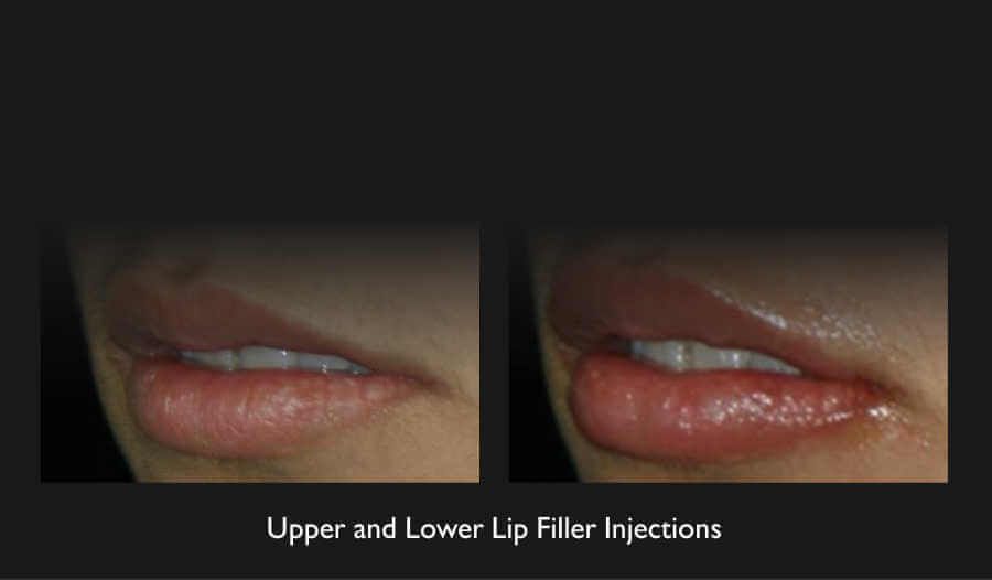 Lip Filler Before & After