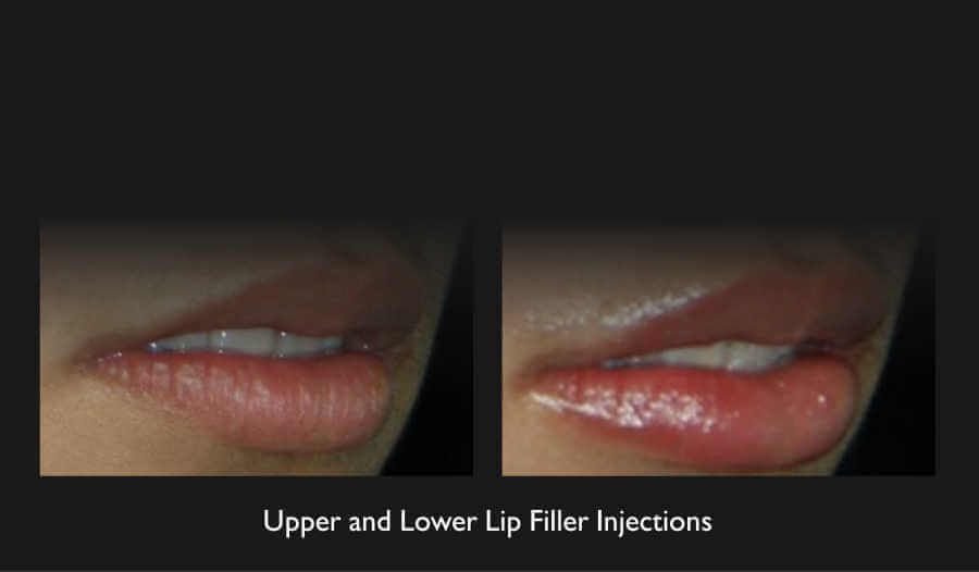 Lip Filler Before & After