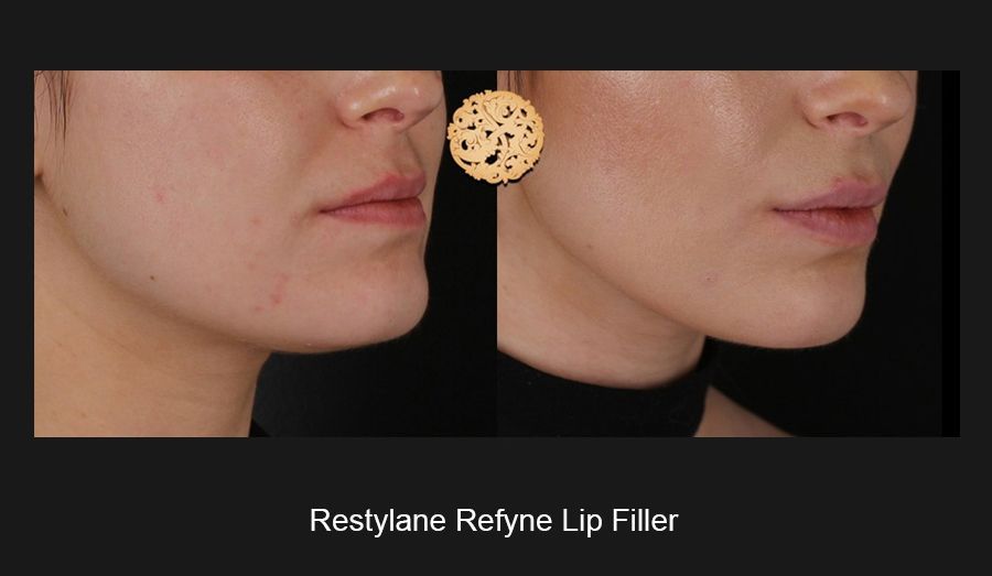 Lip Filler Before & After