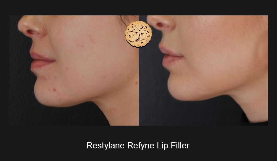 Lip Filler Before & After