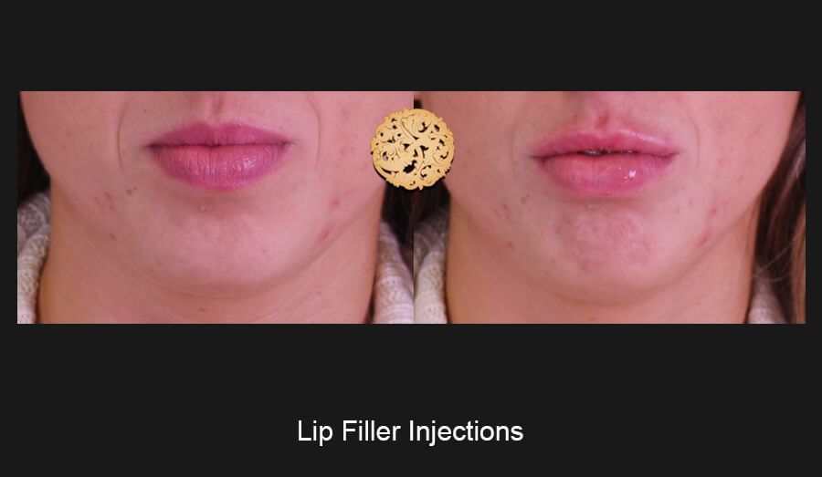 Lip Filler Before & After