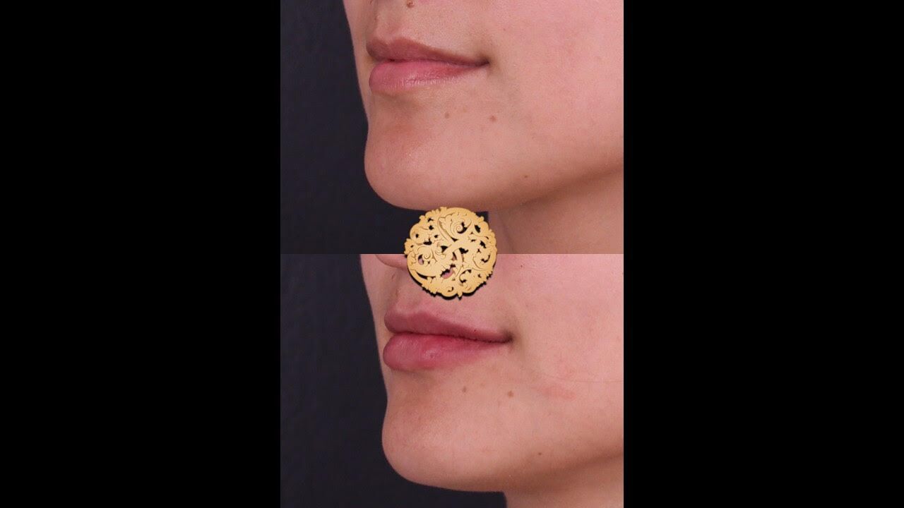 Lip Filler Before & After