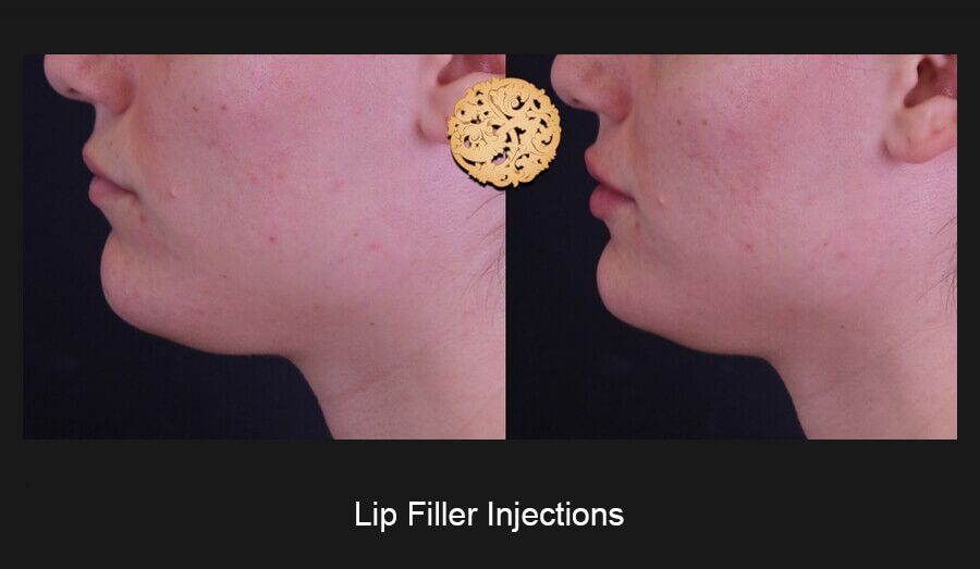 Lip Filler Before & After