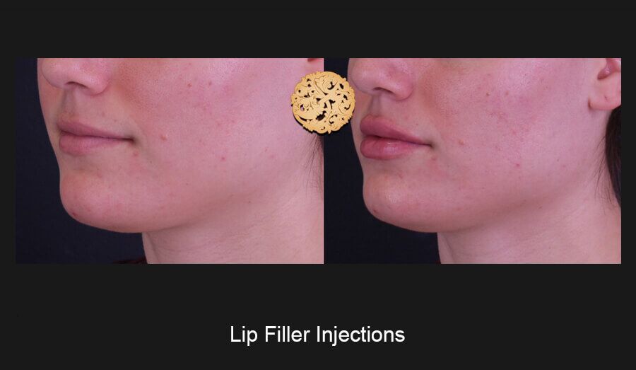 Lip Filler Before & After