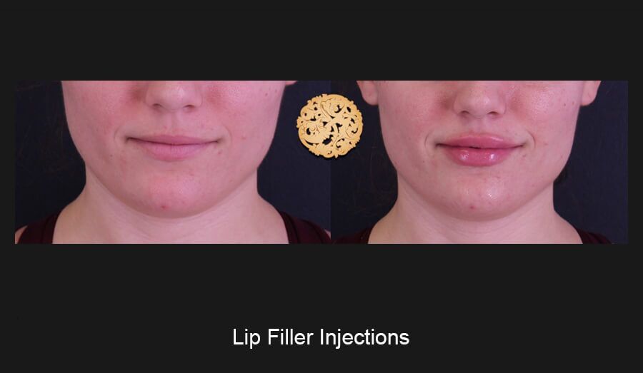 Lip Filler Before & After
