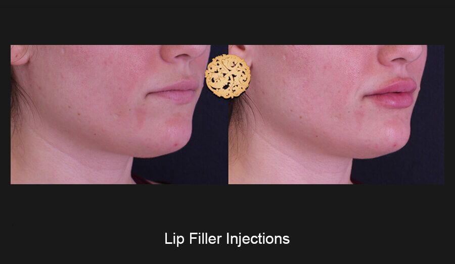 Lip Filler Before & After