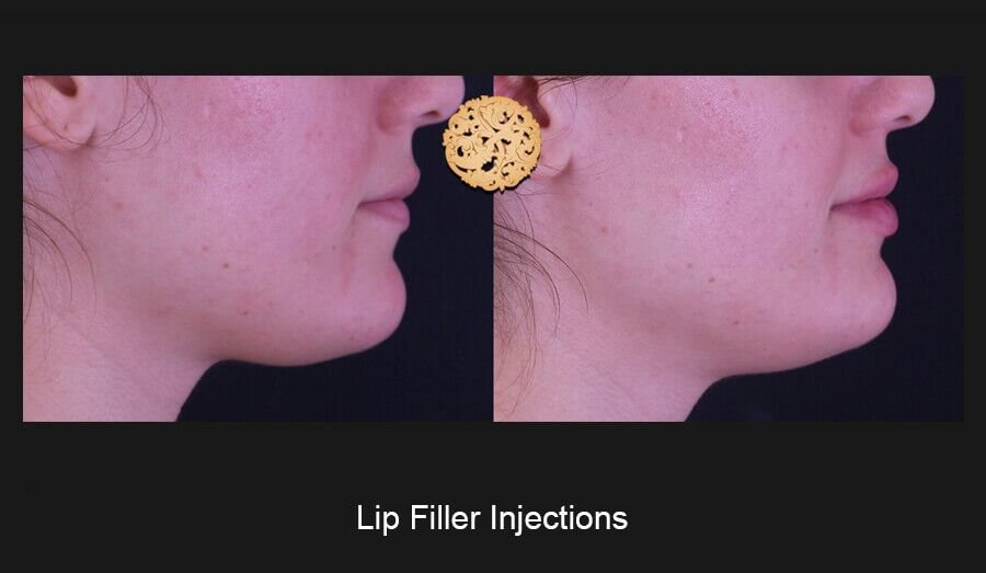 Lip Filler Before & After