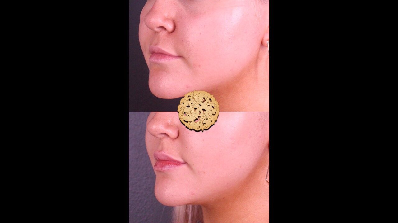 Lip Filler Before & After