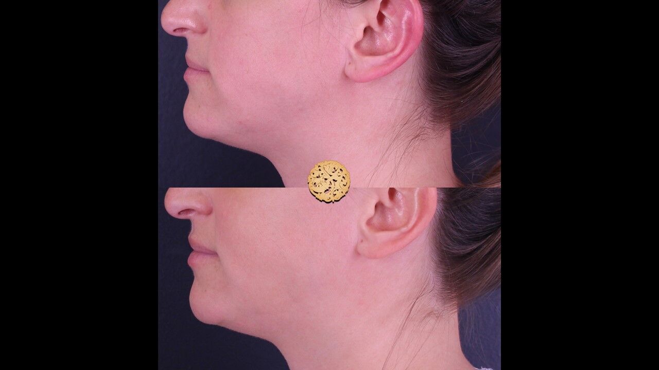 Lip Filler Before & After