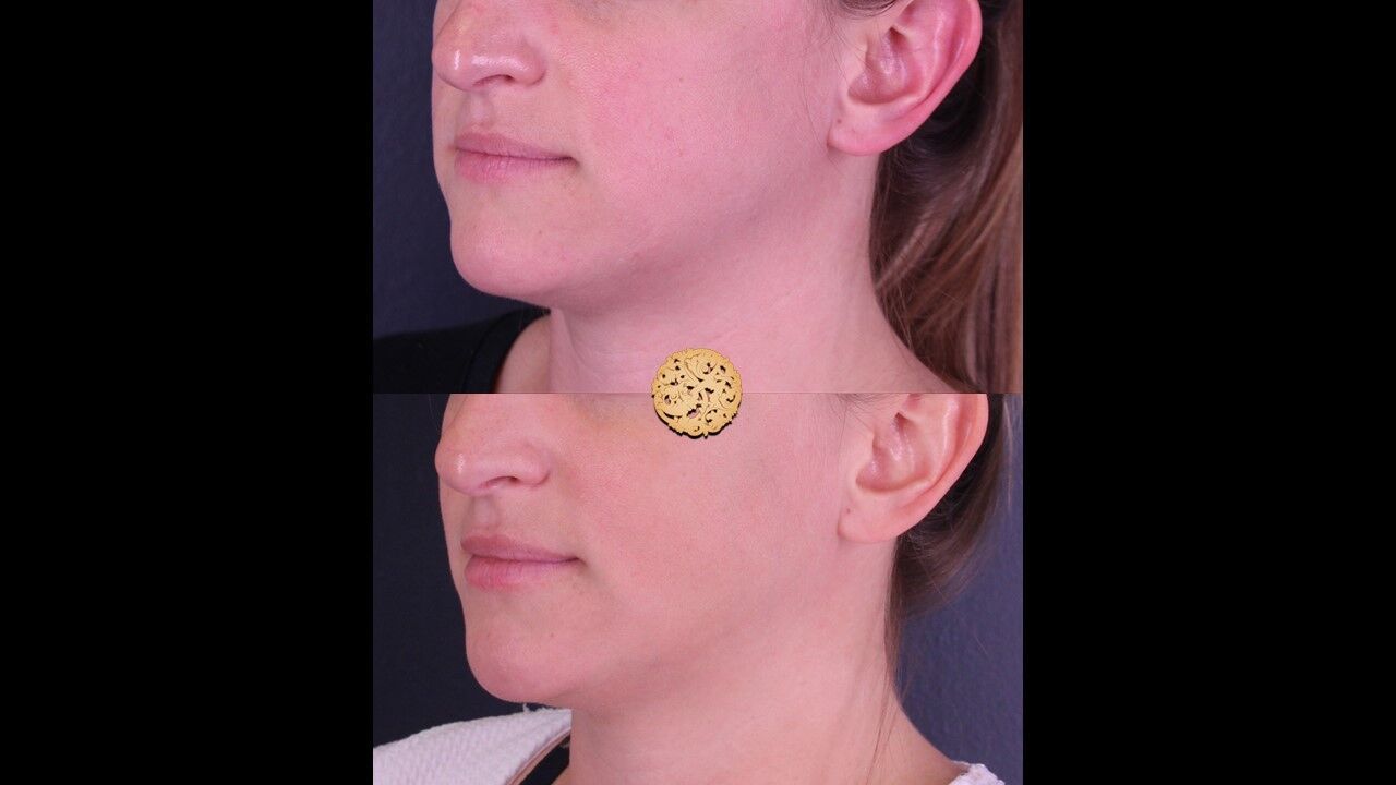 Lip Filler Before & After