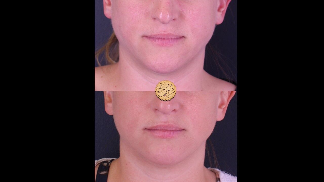 Lip Filler Before & After