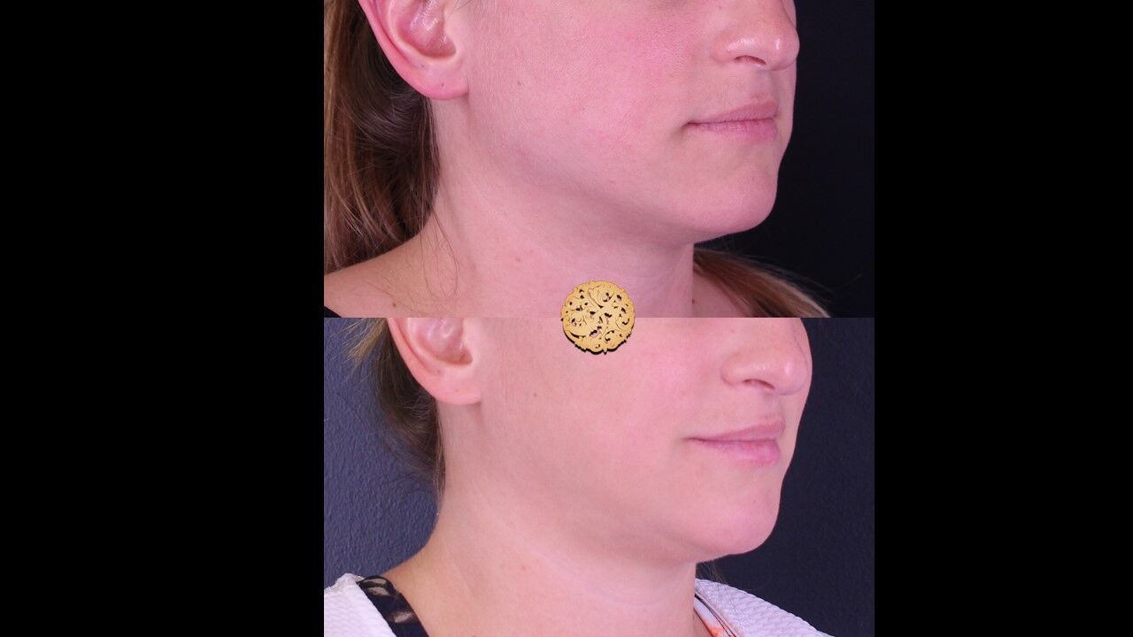 Lip Filler Before & After