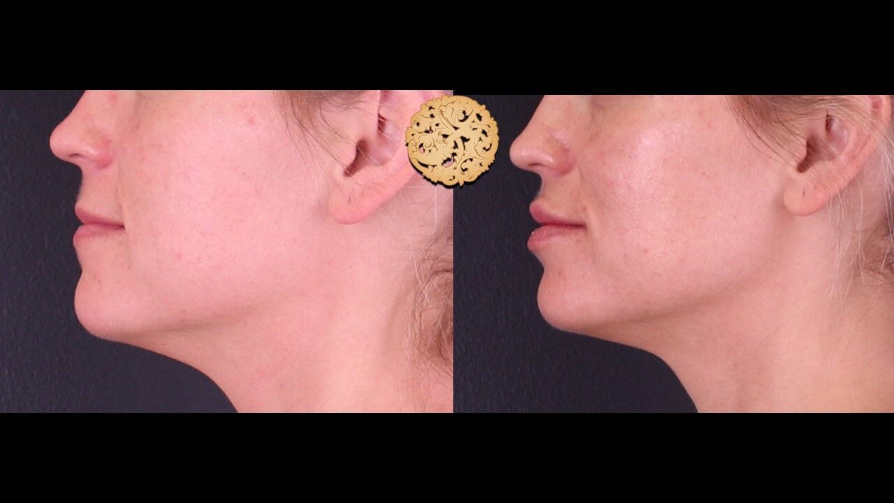 Lip Filler Before & After