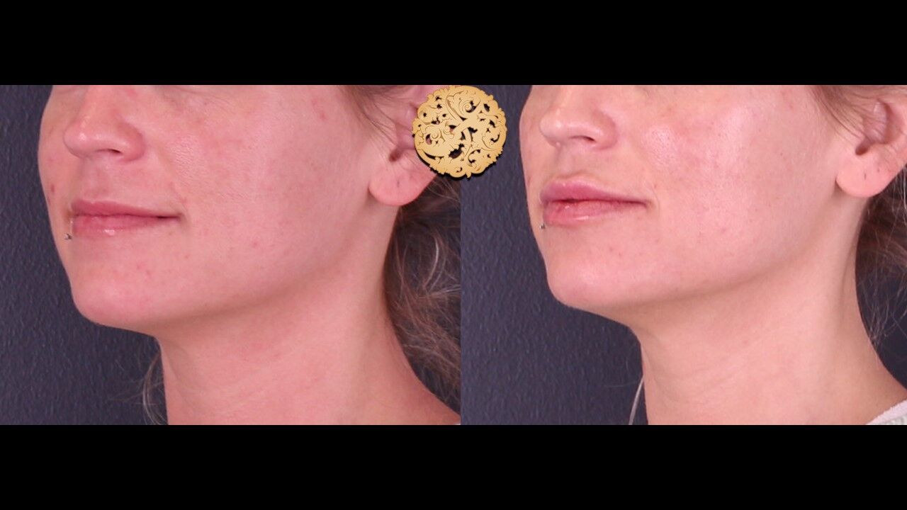 Lip Filler Before & After