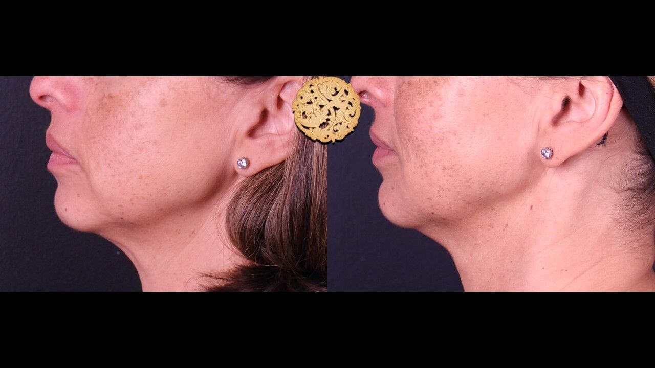 Lip Filler Before & After