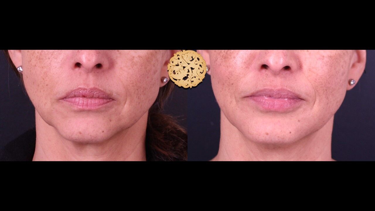 Lip Filler Before & After