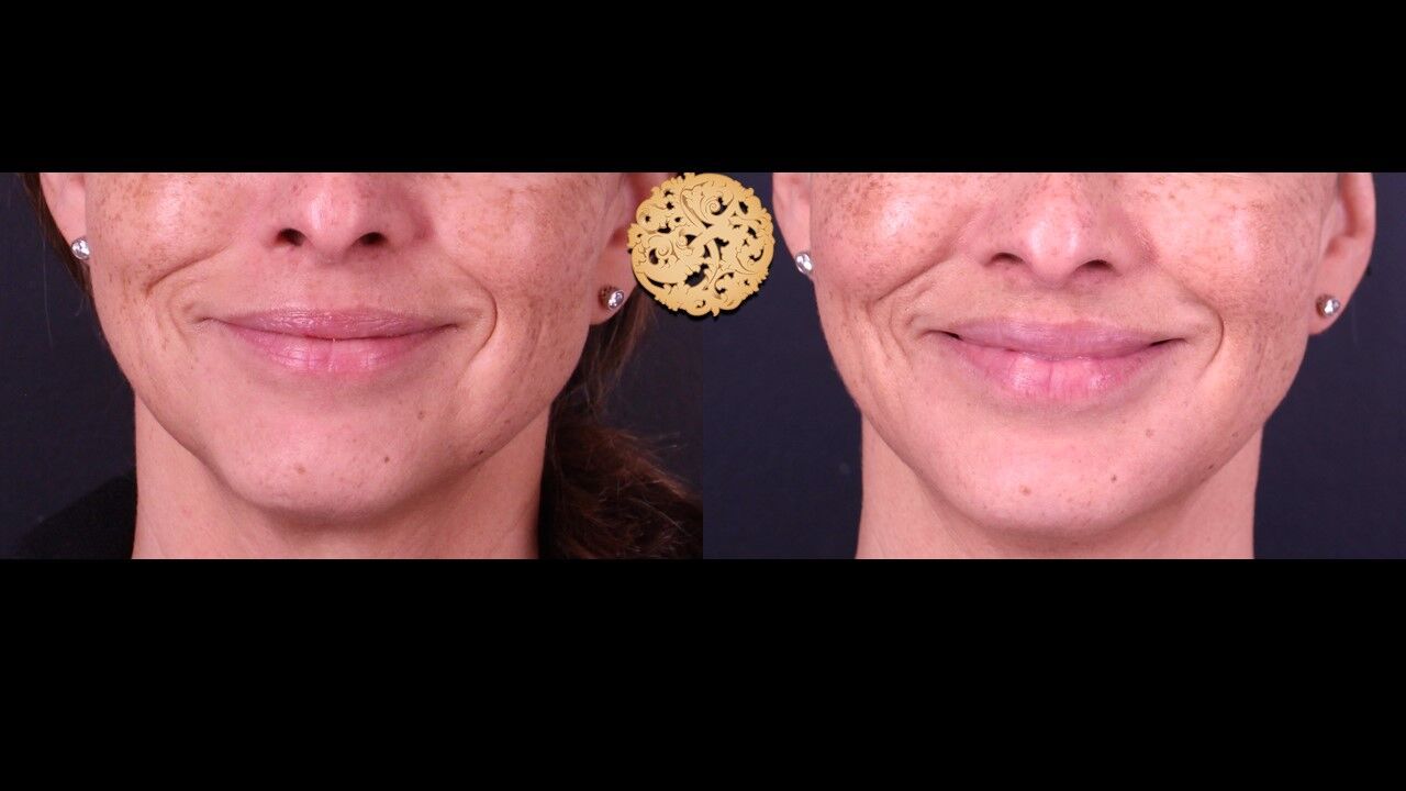 Lip Filler Before & After