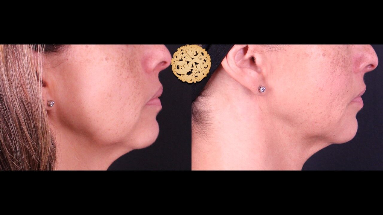 Lip Filler Before & After