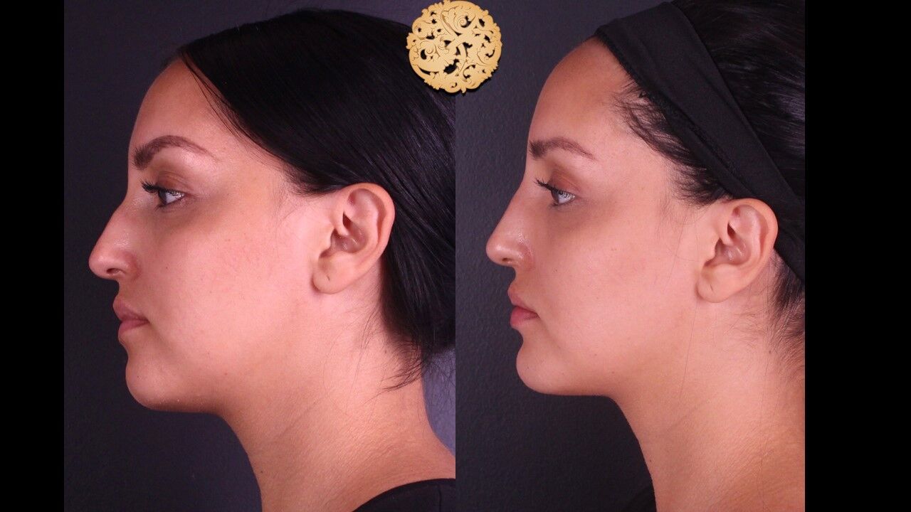 Lip Filler Before & After