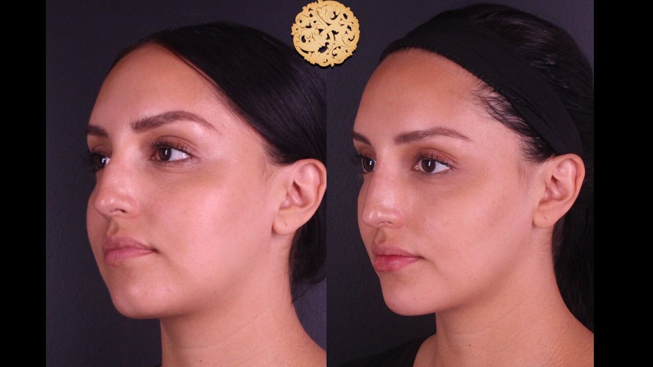 Lip Filler Before & After