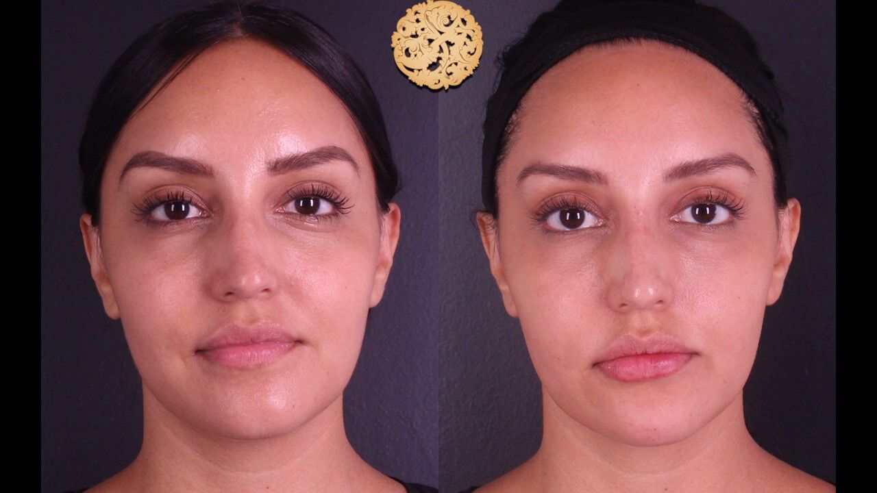 Lip Filler Before & After