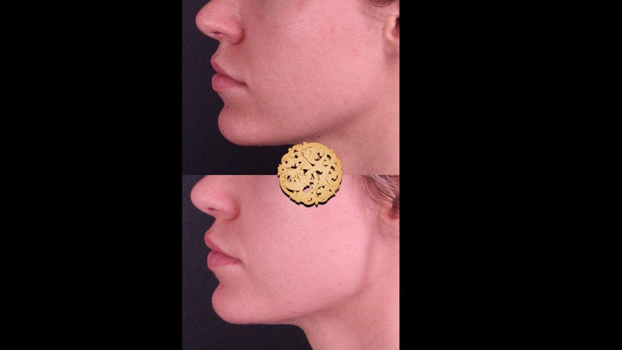 Lip Filler Before & After