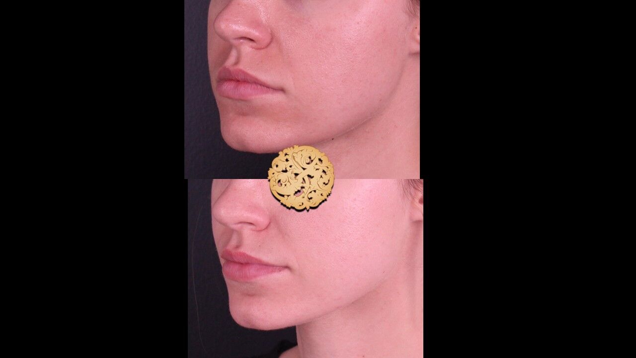 Lip Filler Before & After