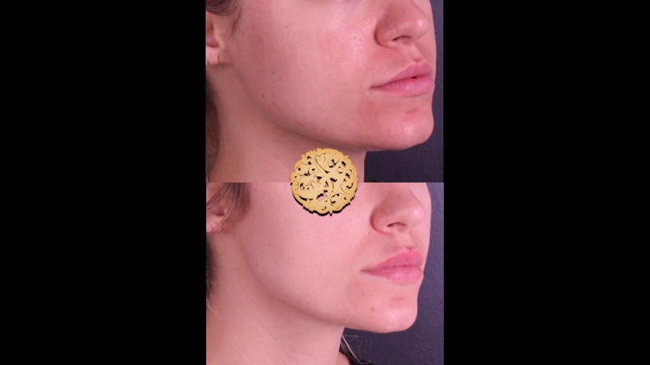 Lip Filler Before & After