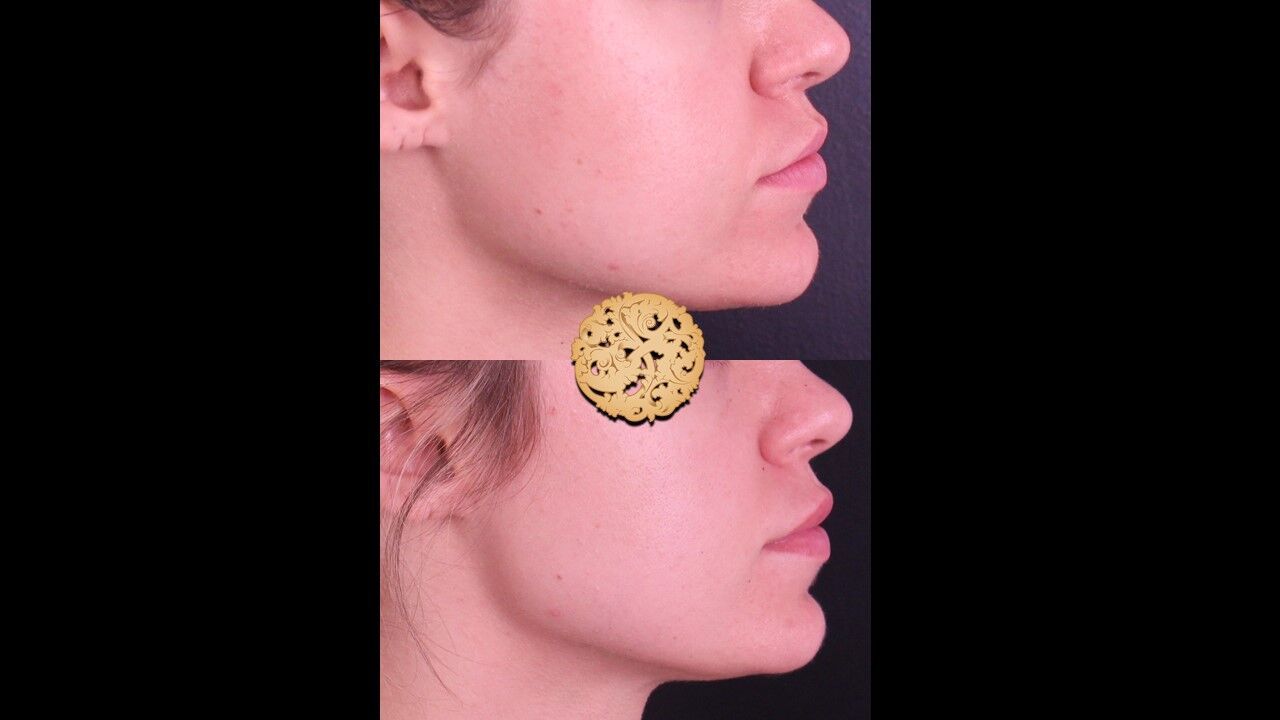 Lip Filler Before & After