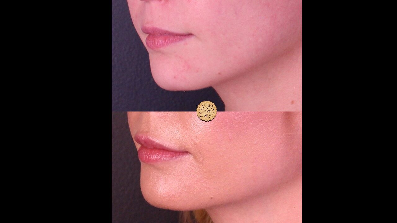 Lip Filler Before & After