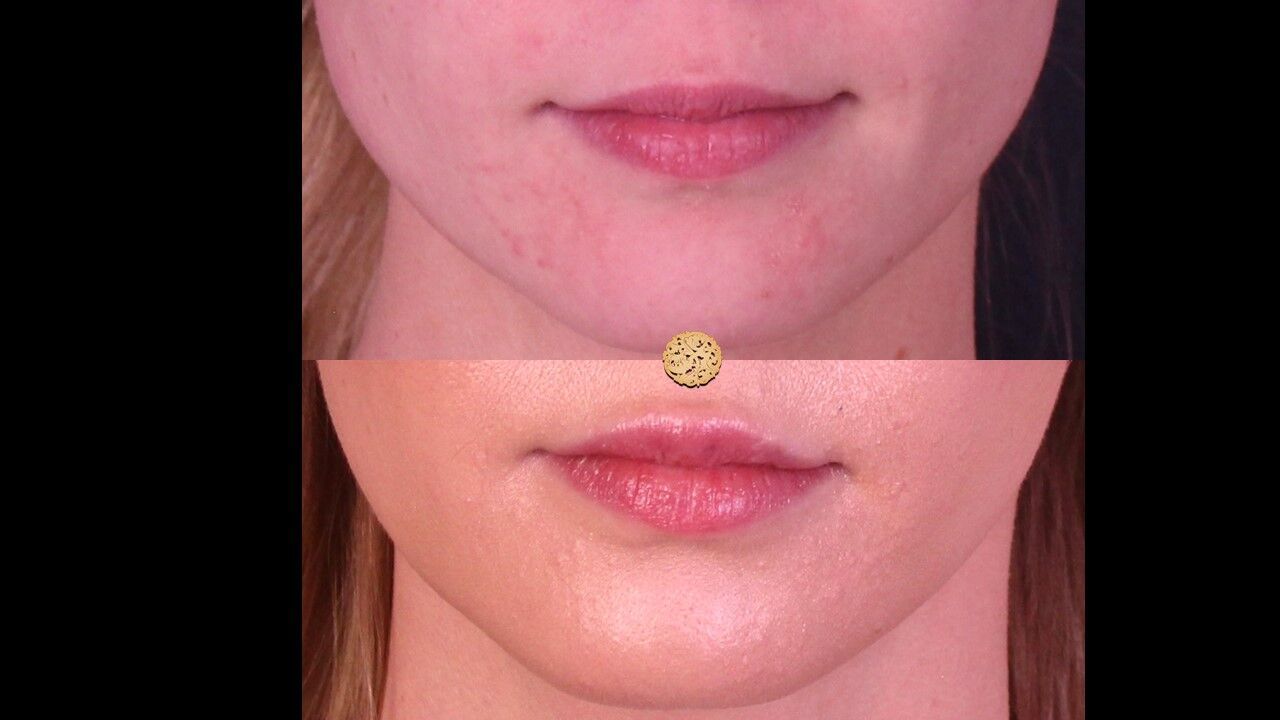 Lip Filler Before & After