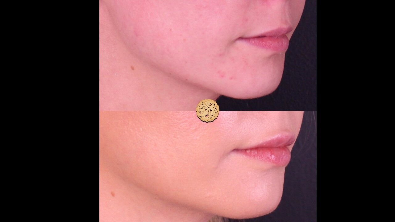 Lip Filler Before & After